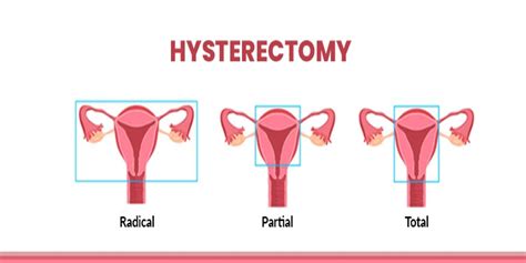 Is Hysterectomy A Right Decision Know Important Aspects About Hysterectomy