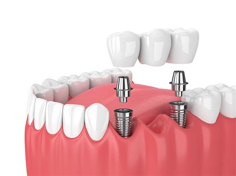 tooth implants  role   abutment implant dentistry