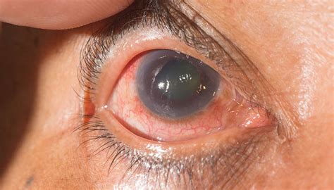 Eye Diseases 10 Common Eye Diseases