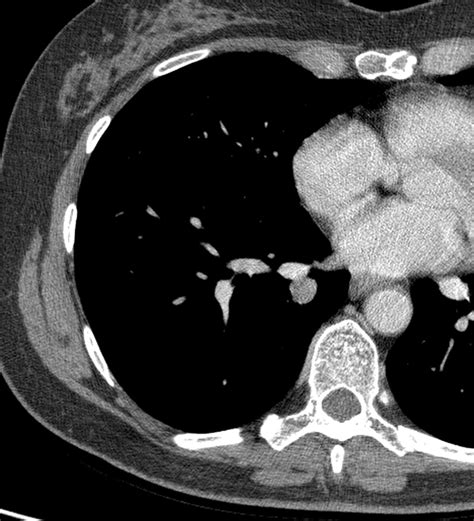 Ct Features Of Peripheral Pulmonary Carcinoid Tumors Ajr