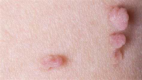 skin tags during pregnancy what to expect