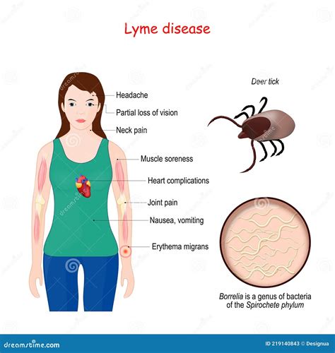 Lyme Disease Woman With Erythema Signs And Symptoms Lyme Borreliosis
