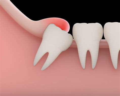 symptoms  impacted wisdom tooth shinagawa orthodontics