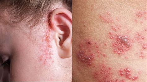 rashes   reveal  dermatologic disease types  rashes psoriasis rash