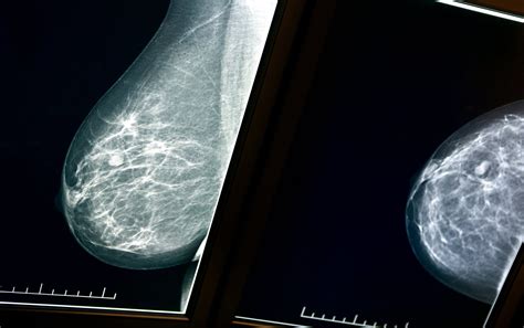 zebra medical vision gets fda clearance for mammography solution