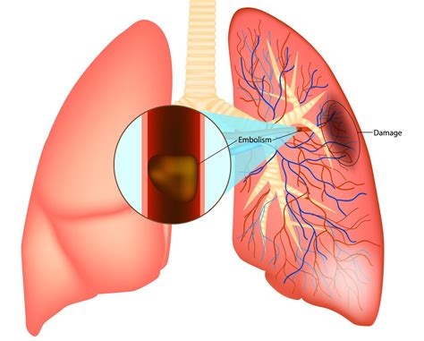 Treatment For Pulmonary Embolism Causes And Symptoms