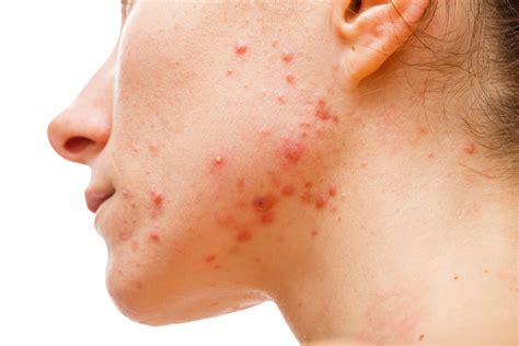 treatment options emerging  acne rosacea