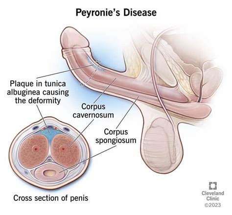 peyronie s disease causes symptoms diagnosis and treatment
