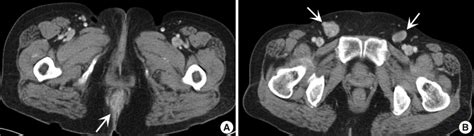 Rare Case Of Anal Canal Signet Ring Cell Carcinoma