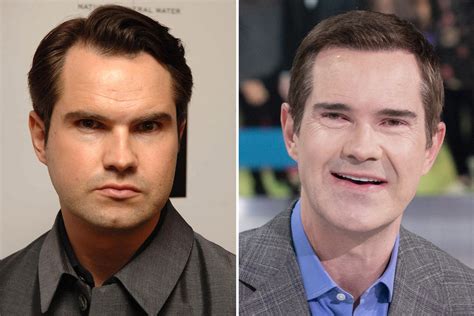 im  hair loss mentor  helped jimmy carr   top tips  cope  thinning  irish sun