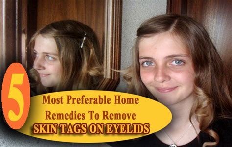 5 most preferable home remedies to remove skin tags on eyelids
