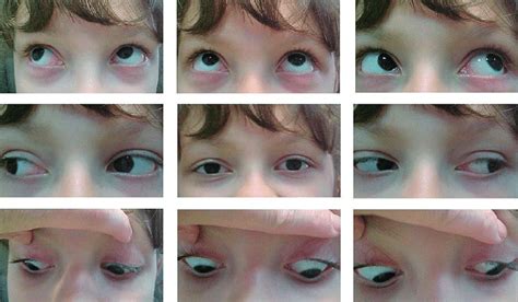 patient demonstrates  full range  movement   eyes   scientific