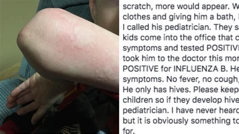 nurse s warning about unexpected flu symptom goes viral