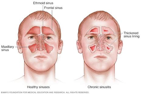 chronic sinusitis disease reference guide