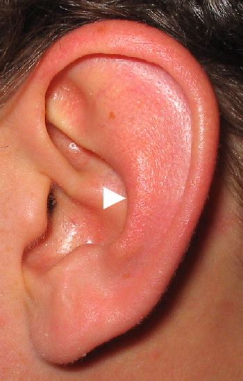 cauliflower ear treatment  auricular hematoma insidesurgery