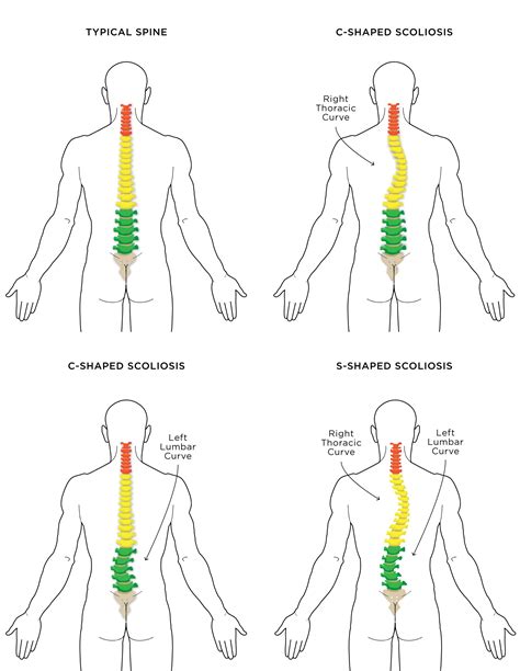 scoliosis and yoga the do s and don ts