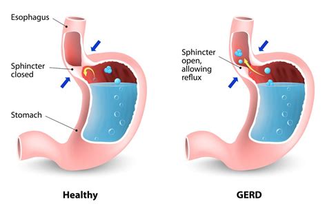 Gastroesophageal Reflux Disease Treatments Gastro Health