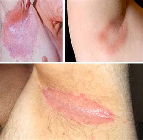 Armpit Rash Pictures Causes Fungi Heat And Treatment