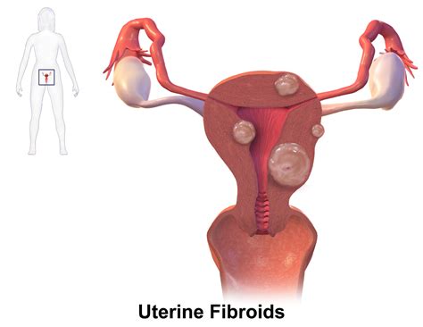 Uterine Fibroid Pain Pelvic Rehabilitation Medicine