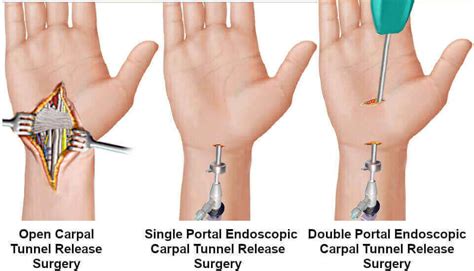 pros cons  endoscopic surgery  carpal tunnel