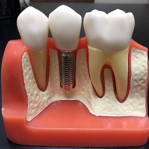 single dental implants  missoula mt  dentistry