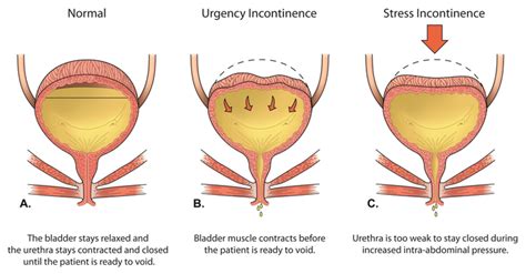 Urinary Incontinence