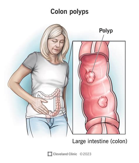colon polyps symptoms  types removal