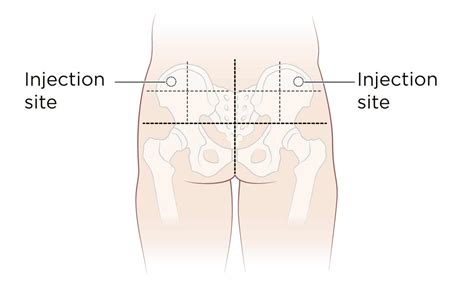 intramuscular injection definition  patient education