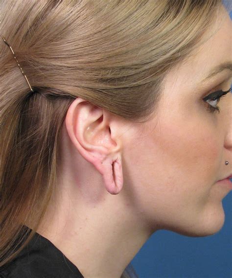 gauge piercing repair  dr john hilinski expert cosmetic ear surgeon