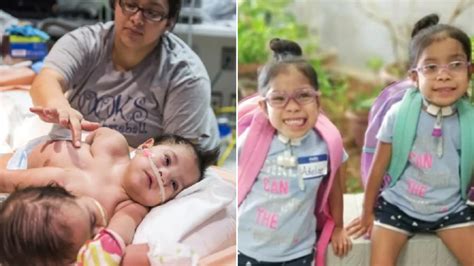 conjoined twins separated after huge surgery thrived and have started