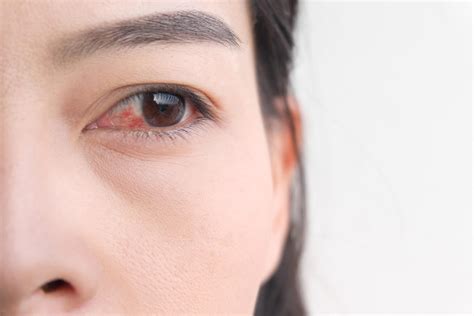 pink eye symptoms  shouldnt ignore readers digest