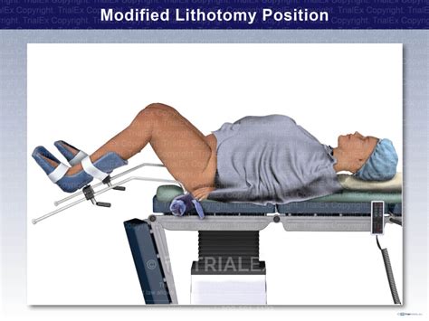 modified lithotomy position trial exhibits