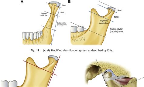 figure   classification  mandibular condylar fractures