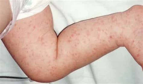 Meningitis Rashes How To Recognize The Disease With Pictures