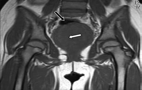 mr image of the pelvis shows the mass on the cervix white arrow at
