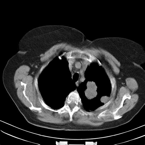 Lung Metastases From Uterine Sarcoma Image