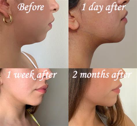 neck chin face liposuction beverly hills los angeles