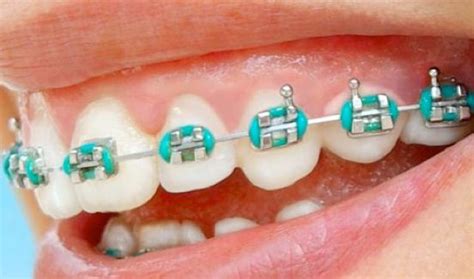 17 Best Images About Cute Colors For Braces On Pinterest Pink Blue