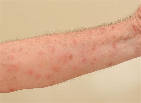 what causes scabies in nursing homes pintas and mullins law firm