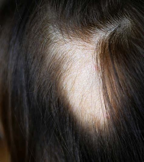 el    alopecia  symptoms  home remedies  hindi