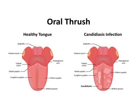 yeast infections have you got one saga