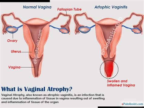 Pictures Of Enlarged Vaginas