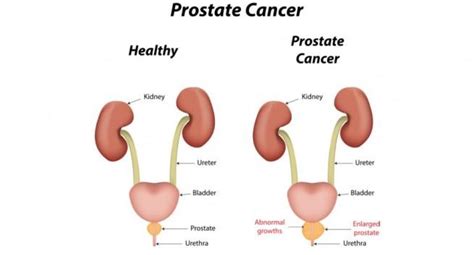Prostate Cancer And Health Health Tips Prostate Cancer