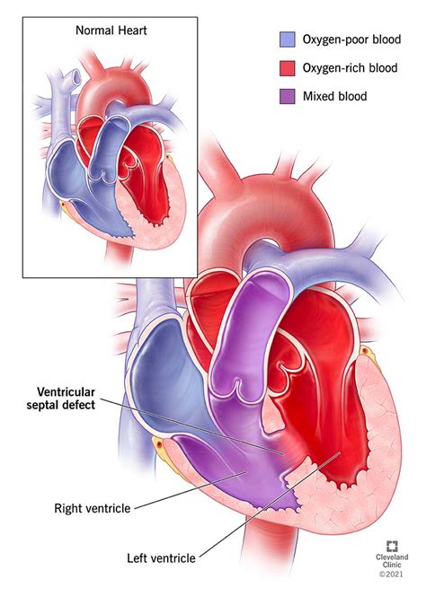 ventricular septal defect vsd    types  symptoms