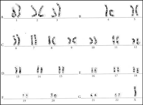 Karyotype Of Turner Syndrome With Monosomy X 45 Xo Download