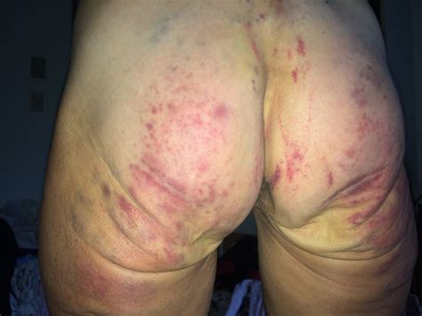 bruised mature ass session 23 pics xhamster