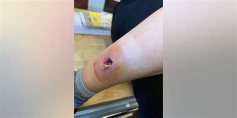 Mom Claims Spider Bite Left Son With Gaping Hole In Leg Fox News