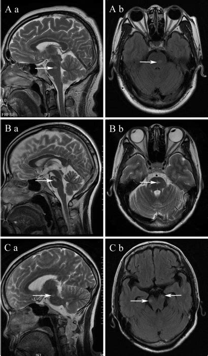 Brain Stem Lesions Arrows On Mri Of Multiple Sclerosi Open I