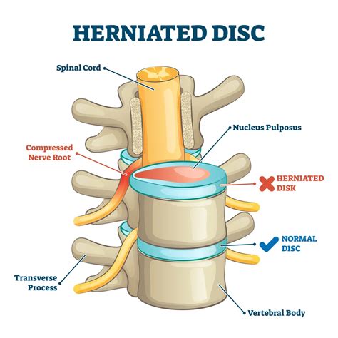 disc herniation explained premia spine