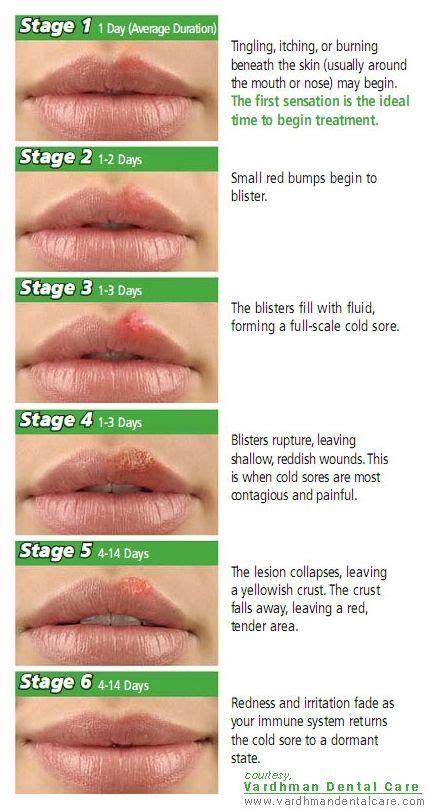 cold sores stages  progression   lesion dental awareness